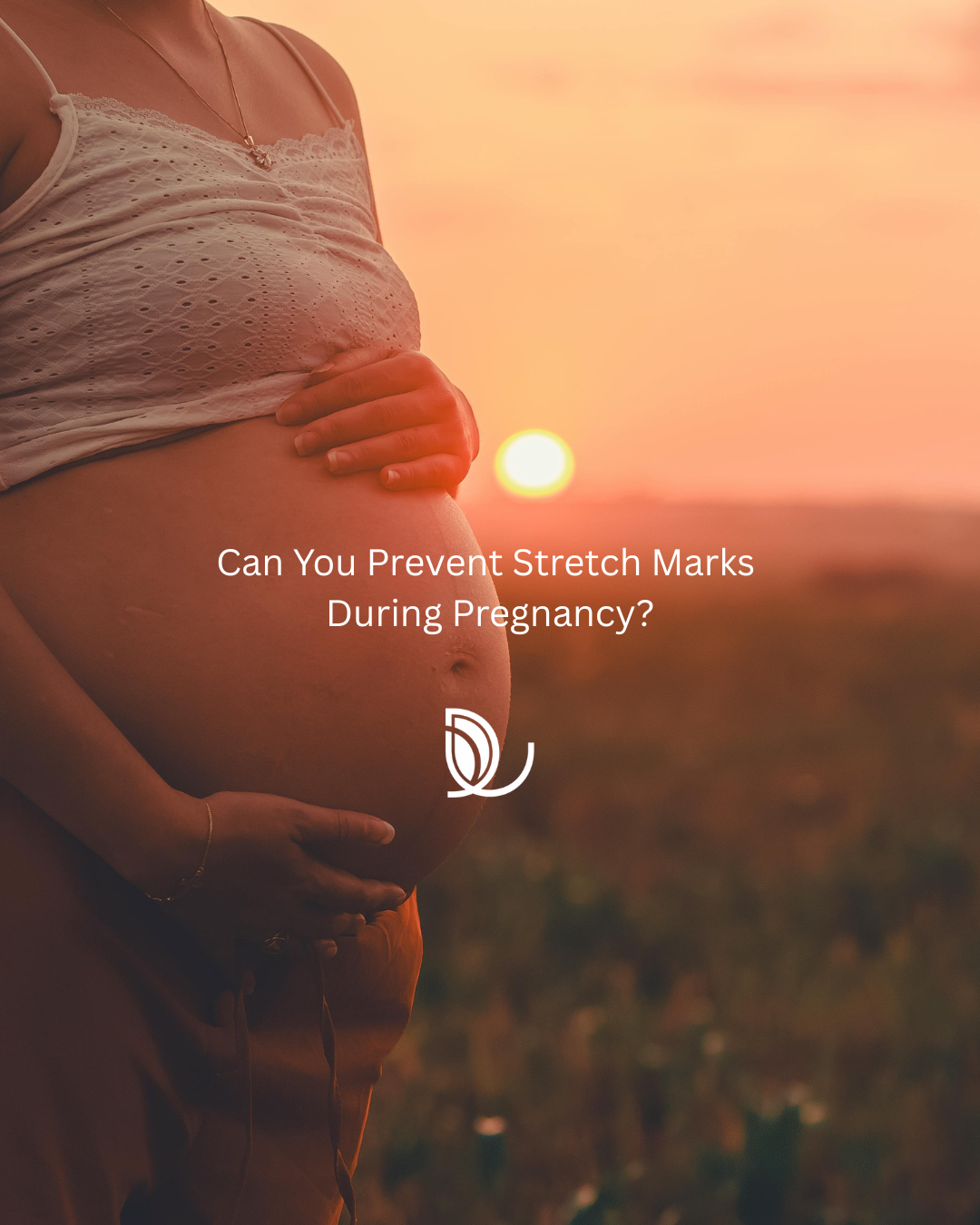 Can You Prevent Stretch Marks During Pregnancy?